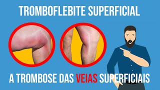 Tromboflebite Superficial a trombose das veias superficiais [upl. by Sekyere]