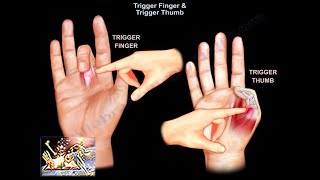 Trigger Finger amp Trigger Thumb  Everything You Need To Know  Dr Nabil Ebraheim [upl. by Streeter443]