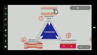 Virchows Triad Thrombosis General Pathology [upl. by Presber]