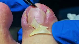 Dig Out Ingrown Toenails FAST with These Simple Steps [upl. by Mccartan99]