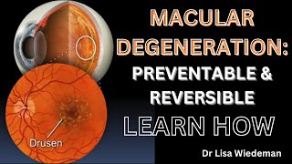 Easy to Understand Explanation PROTECT YOURSELF FROM LOSING VISION from Macular Degeneration [upl. by Brittney360]