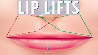 Lip Lifts  Surgical Lip Procedure [upl. by Dirk]