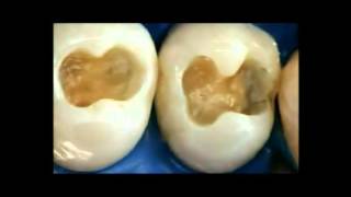 EQUIA Restoring the Posterior Dentition  Case 2 Video [upl. by Celestia]