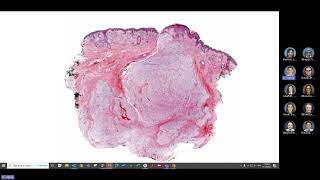 GYN soft tissue tumor pathology [upl. by Haidebez638]