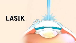 LASIK Surgery and its Risks [upl. by Yme]