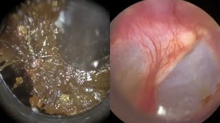 173  Ear Wax Removal In Bruised Ear Stained with Blood due to Cotton Swab Misuse with the WAXscope [upl. by Woo]