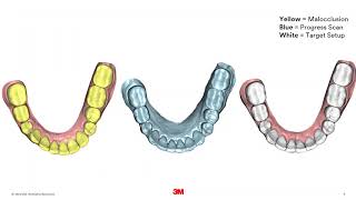 3M™ Clarity™ Aligners Case Study Dr Hughes [upl. by Souvaine523]