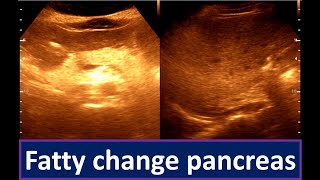 Moderately diffuse fatty infiltration of the Liver  Fatty change pancreas [upl. by Declan]