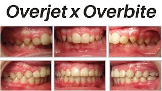 Overjet x Overbite  explicação [upl. by Olegnalehcim]