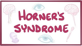 Horners syndrome  causes symptoms diagnosis treatment pathology [upl. by Nyrhtac]