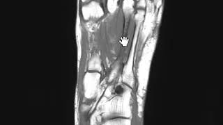 Metatarsal stress fracture by MRI [upl. by Reinhardt]