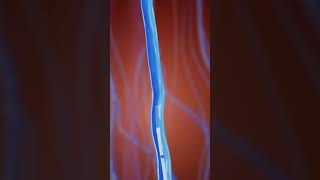 Varicose Veins  Endovenous Laser Treatment [upl. by Eahc833]