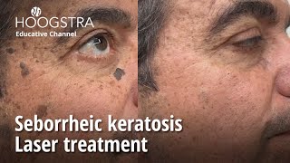 Seborrheic keratosis  Laser treatment  22341 [upl. by Heidie114]