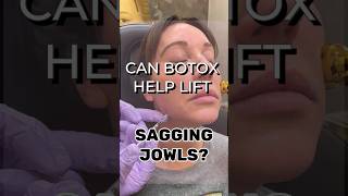 The use of Botox to treat sagging jowls saggyjowls jowls aesthetics agelessbeauty antiaging [upl. by Eenet869]