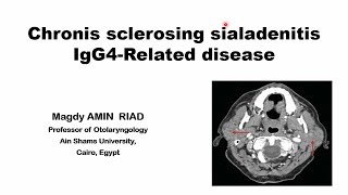 Chronic Sclerosing Sialadenitis IgG4 Related disease [upl. by Eric]