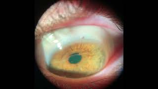 Video of Ampleye Scleral Lens [upl. by Loyce662]