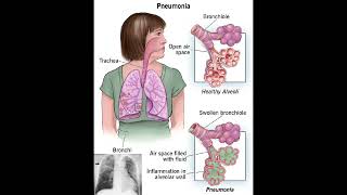 Pneumonia symptoms shorts trending science pneumonia disease [upl. by Aynotahs]