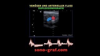 Duplexsonografie  Venöser und arterieller Fluss [upl. by Switzer]