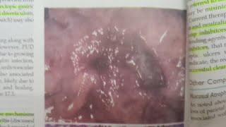 Peptic Ulcer Disease  SPECIAL PATHOLOGY [upl. by Mitch134]