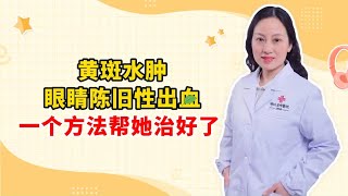 黄斑水肿 眼睛陈旧性出血 一个方法帮她治好了 [upl. by Modnar]