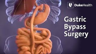 Gastric Bypass Surgery  Duke Health [upl. by Naget]