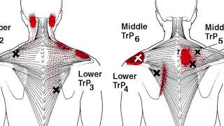 Skulder og nakke dry needling langvarig smertelindring [upl. by Ettevey798]