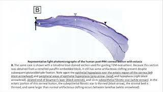 Corneal Ectasia Basics – A Deep Dive [upl. by Cleave971]