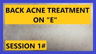 Back ACNE Treatment on quotEquot SESSION 1 [upl. by Dich]