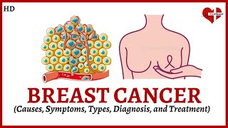 Overview of Breast Cancer Causes Symptoms Types and Treatment Explained [upl. by Aitel]