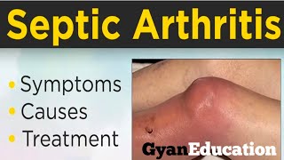 Septic Arthritis kya haifull treatment kya haiGyanEducation11 [upl. by Yenrab]