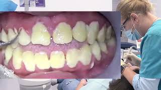 Teeth cleaning  removal tartar and plaque duet scaling [upl. by Otrepur]