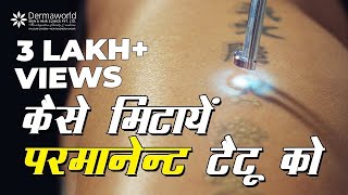 How To remove Tattoo Permanently  कैसे मिटायें परमानेंट टैटू को [upl. by Nelyk]