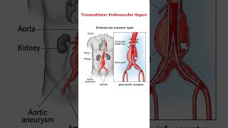 Transcatheter Endovascular Repair Procedure  Aorta endovascularrepair rajinikanth [upl. by Ailimat]