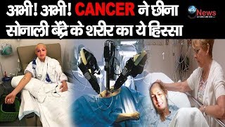 जानलेवा CANCER ने खराब किया सोनाली बेंद्रे के शरीर का ये हिस्सा ये हैं आखिरी STAGE का दर्दनाक इलाज [upl. by Sura447]