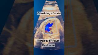 Tetrology of Fallot  Fetal echo  Dr Surbhi Gupta Aggarwal [upl. by Otcefrep]