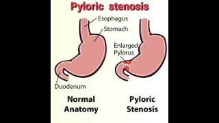 Pyloric stenosis Fluid calculation mrcpch Recall Communication [upl. by Elletnuahs312]