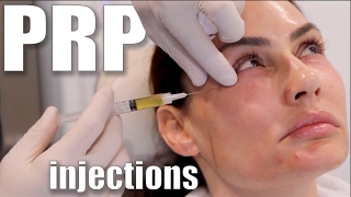 PRP Injections to Face and Neck Blood Facial [upl. by Eudo]