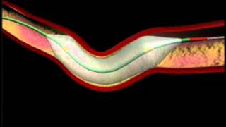 Balloon Angioplasty and Stenting Animation [upl. by Sadonia]