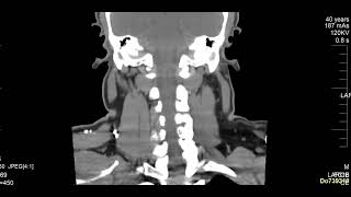 case 10  hoarseness of voice [upl. by Aubrey]