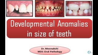 Developmental disturbances in Size of teeth [upl. by Trellas]