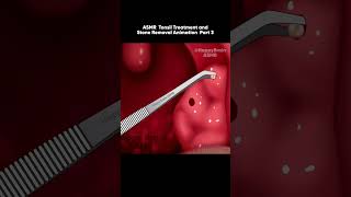 ASMR Tonsil Treatment and Stone Removal Animation Bad Breath Part 3 [upl. by Sivrad257]