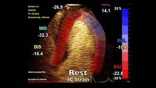 Stress Echo Dobutamine Contraste Sonovue Strain [upl. by Dannel]