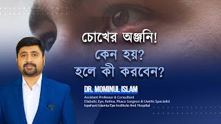 Chalazion treatment চোখের অঞ্জনি কেন হয়Dr Mominul Islam [upl. by Giles781]