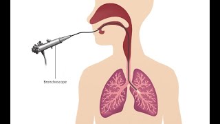 Mediastinoscopy CPT code  simplify medical coding [upl. by Rocker]