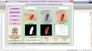 Skin Disease Detection Using Image Processing Matlab Project Code [upl. by Thema]