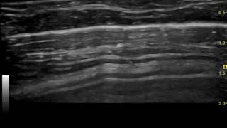 Ultrasonography of feline pneumothorax [upl. by Keyser383]