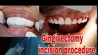 Gingivectomy incision procedure  gum cutting [upl. by Aitnahs]