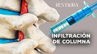 Infiltración de columna ¿Qué es ¿Qué se inyecta ¿Cuánto dura el efecto [upl. by Petronilla]