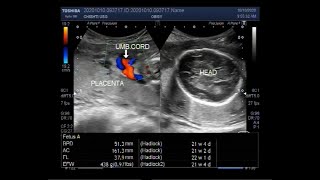 Ultrasound Video showing extreme of Oligohydromnios is Anhydramnios [upl. by Eduj215]