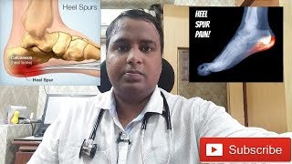 HEEL PAINCALCANEAL SPUR TREATMENTएड़ी के दर्द का इलाज [upl. by Nylesoy]